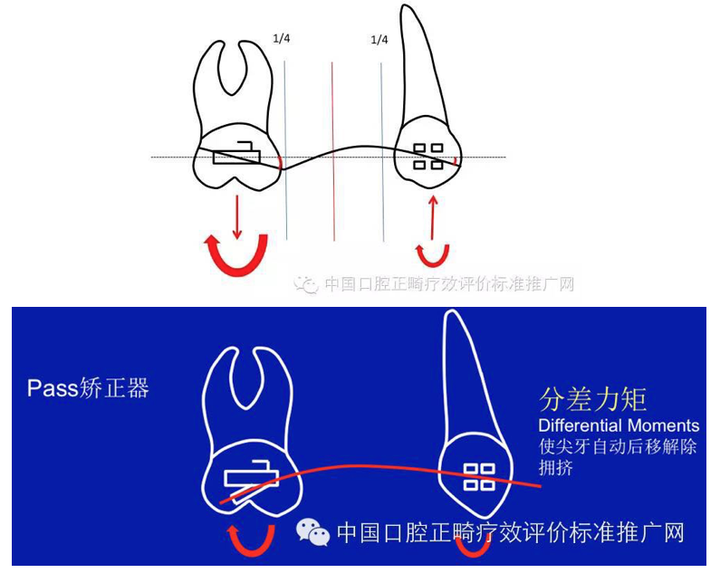 后倾管可以容纳0.018英寸以下尺寸的弓丝.