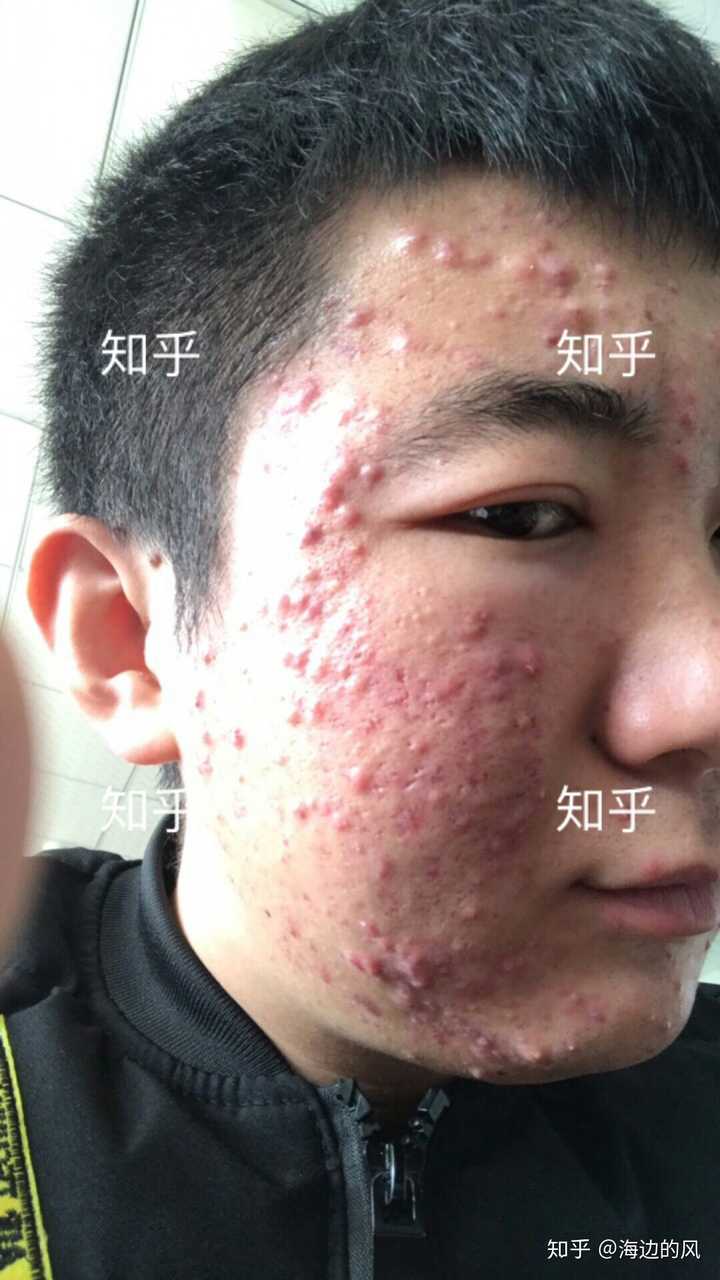 是额头痘痘,脸颊痘痘,下巴痘痘,首先我们先弄明白长痘痘的原因是什么