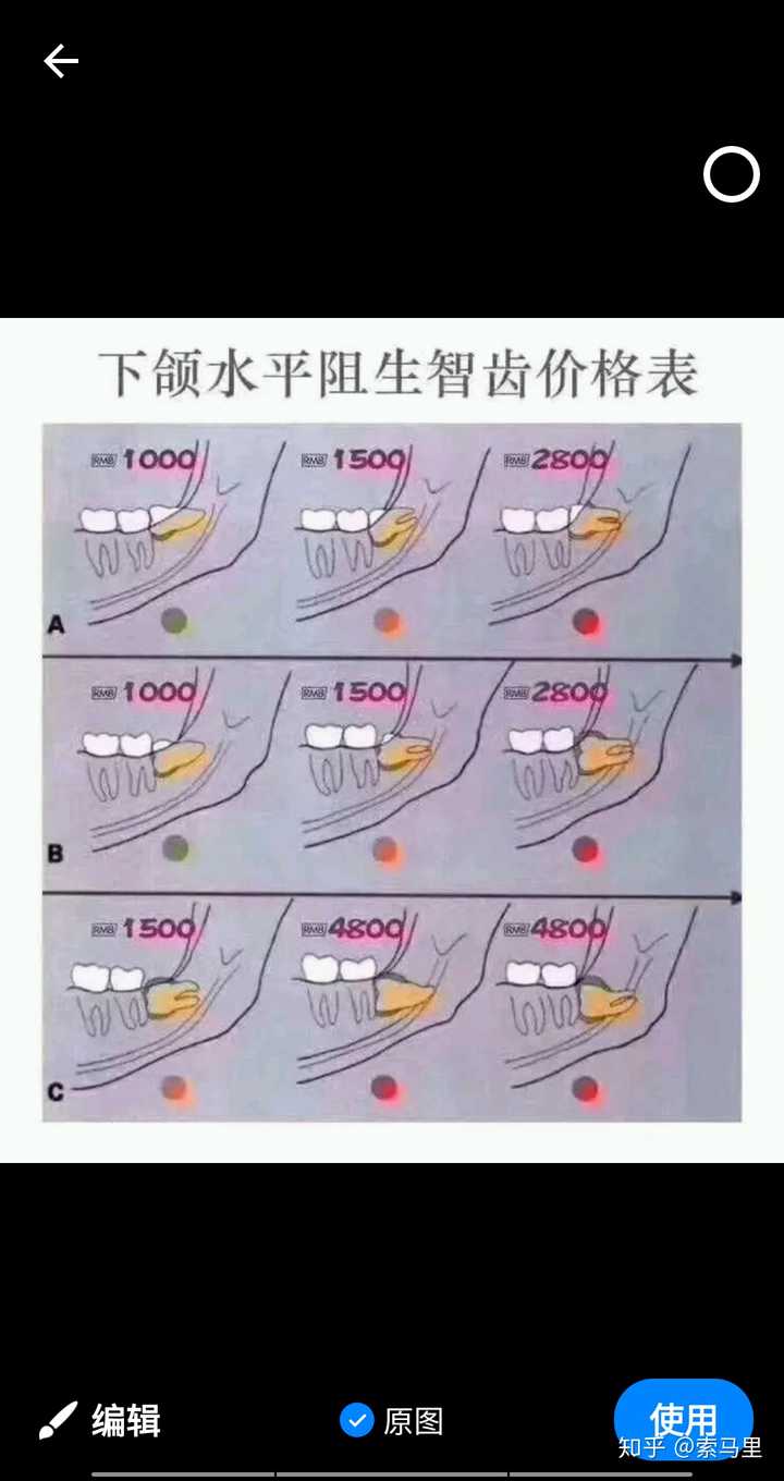 拔牙一共要多少钱?