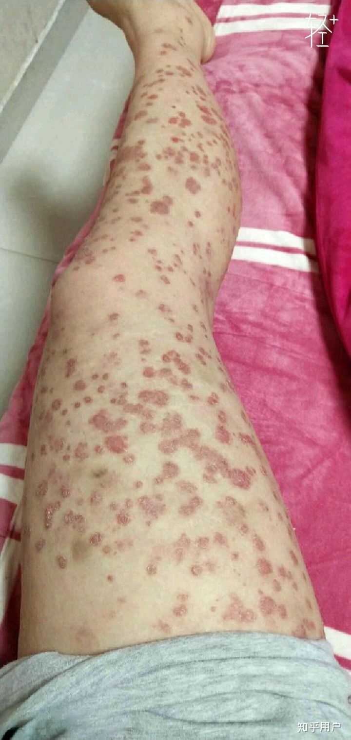 点滴型银屑病怎么破