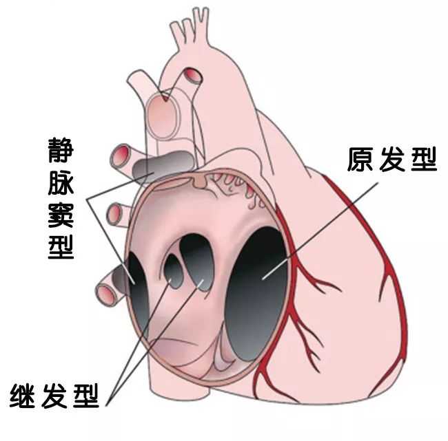 先心病房间隔缺损多大必须手术?