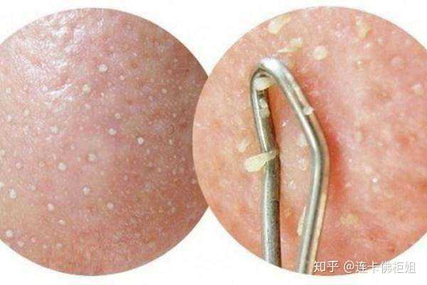 典型的黑头,毛孔里一颗一颗的油脂颗粒(角栓)