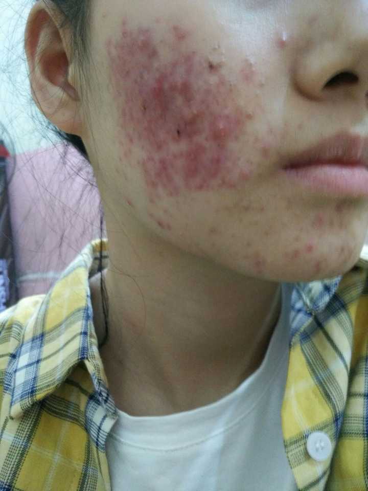 如何拯救被痘痘侵蚀的烂脸
