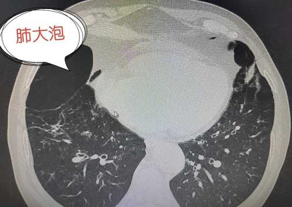 肺大泡怎么治疗: 如果肺大泡没有给患者带来明显的症状,可以用药物