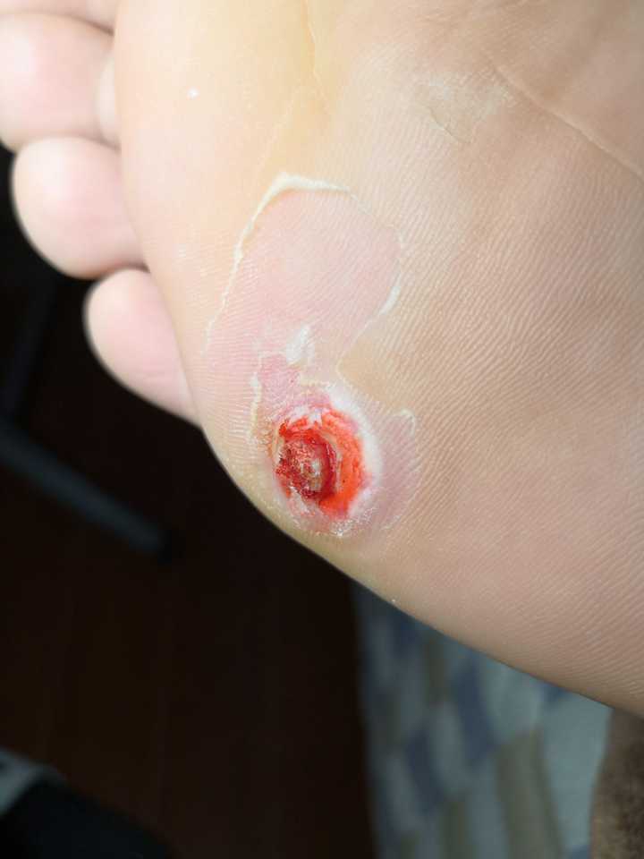 怎么治疗鸡眼?