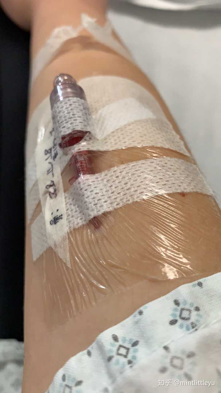 化脓性扁桃体炎多久能好?
