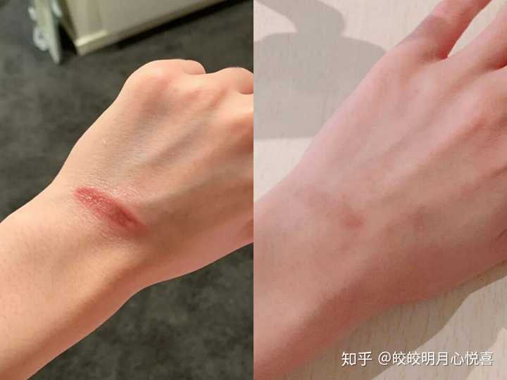 烫伤疤痕应该怎么修复?