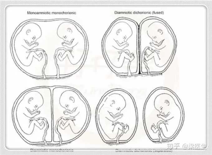 试管婴儿移植2个胚胎会分裂成3胎或者4胎吗?有多胎妊娠的风险吗?