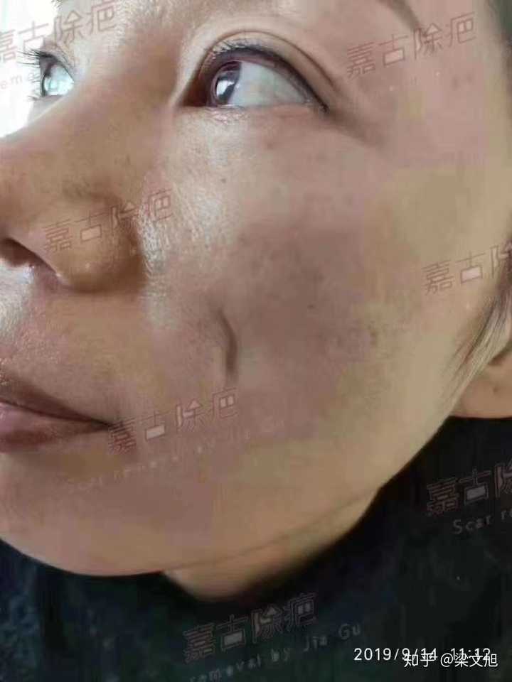 脸上有凹坑疤痕怎么救?