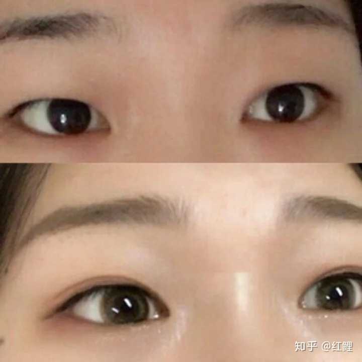 开眼角,眼睛变大是什么体验?