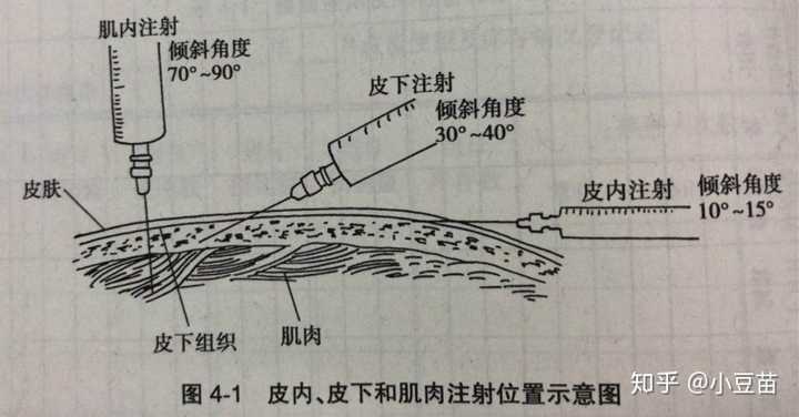 有一句接种部位的描述: 「本品肌肉注射,首选接种部位为 上臂三角肌