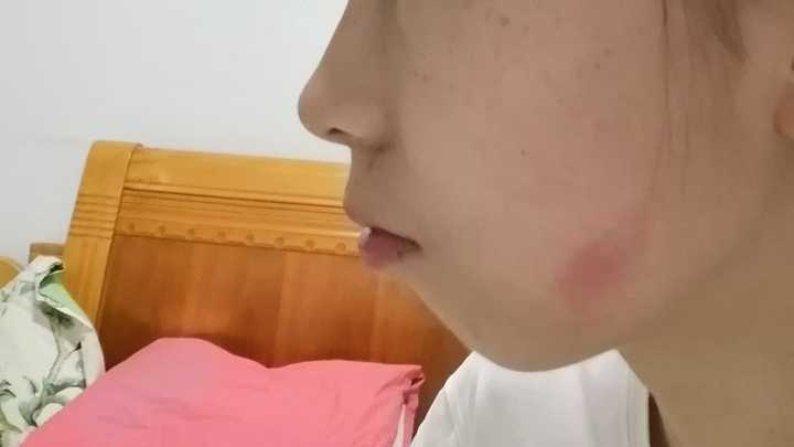 红色的印子是被虫子咬了