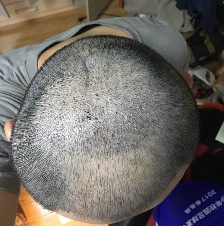 过程,不过关于这一点老徐之前也有过回答,可以参考: 老徐:植发是怎么