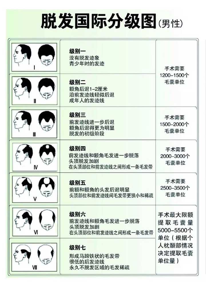 谢邀,脱发是分级的