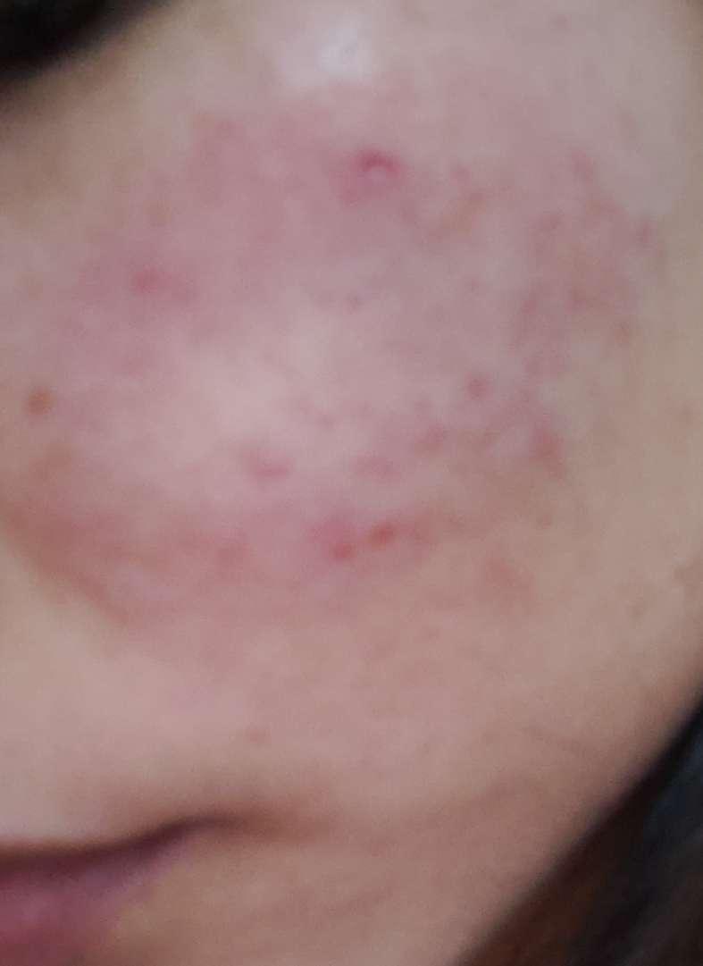 一周前诊断出感染了脸部感染糠秕孢子菌,脸变成这个样子(也怪我自己手