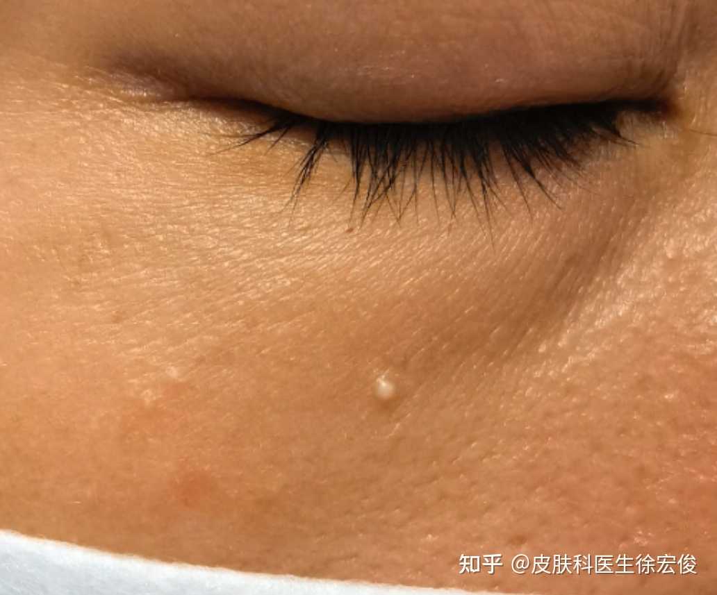 皮肤科医生徐宏俊 的想法: 脸上的脂肪粒就是这颗白色的小丘疹,它的