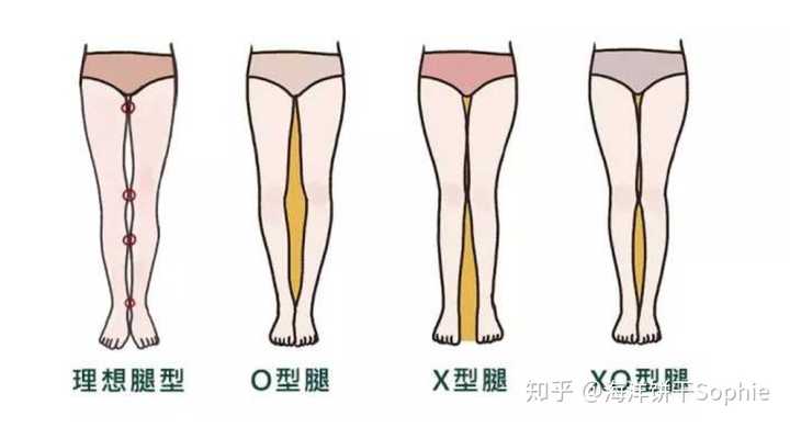 当你站直时,双腿并拢,膝关节可以靠拢但是踝关节不能靠拢,就是x型腿.