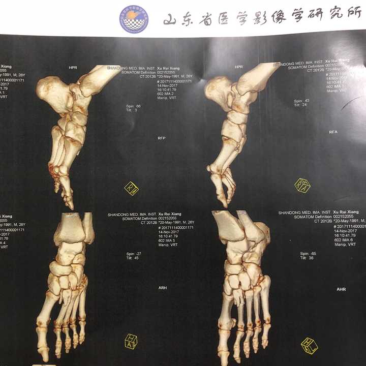 左脚第二跖骨骨折需要多久才能正常走路