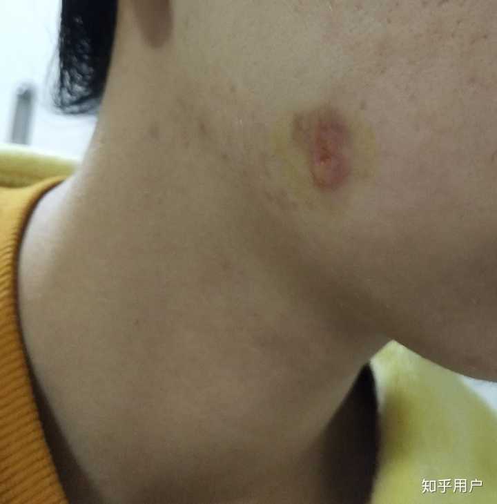 皮脂腺囊肿长在脸上了,医生说只能手术?