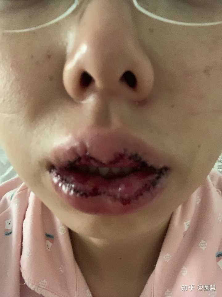 有什么方法可以把嘴唇变薄,不用手术?
