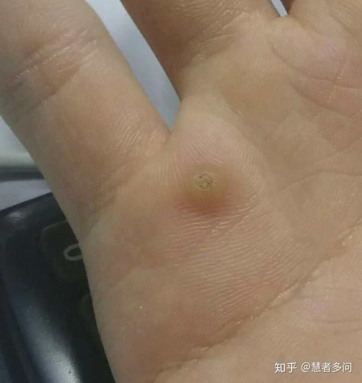 手掌的侧面(左手小拇指一侧)长了个水泡一样的硬泡.越来越大.