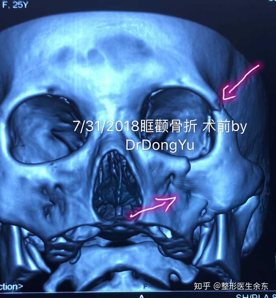 眼眶骨折,手术方式是眶颧骨折复位固定 … - 知乎