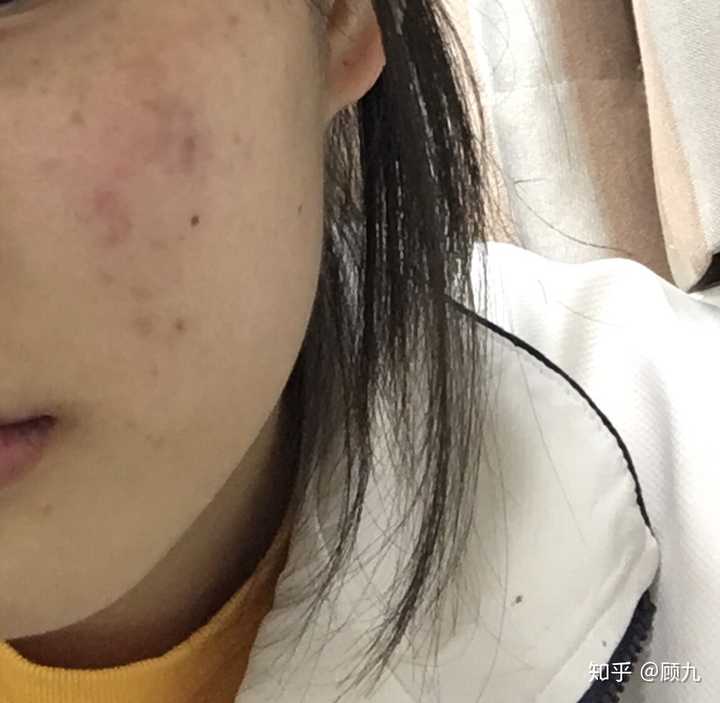 男生是不是不会喜欢脸上有痘印或痘痘的女孩子啊?
