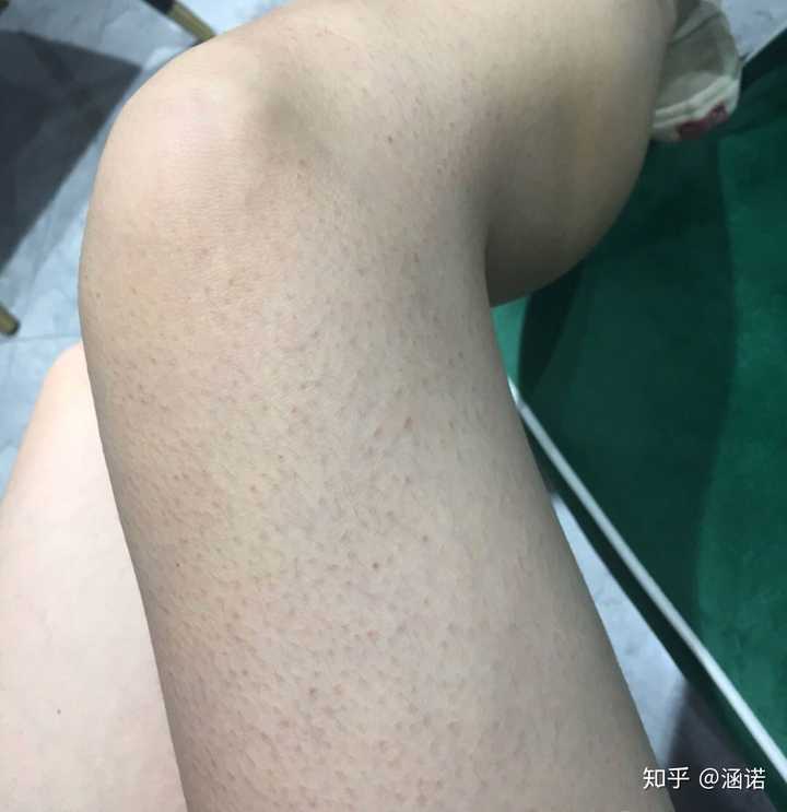 男生鸡皮用啥身体乳?