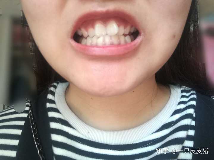 这么一看牙还挺白…可能是人黑对比的…牙齿不整齐,两颗门牙呈现内八