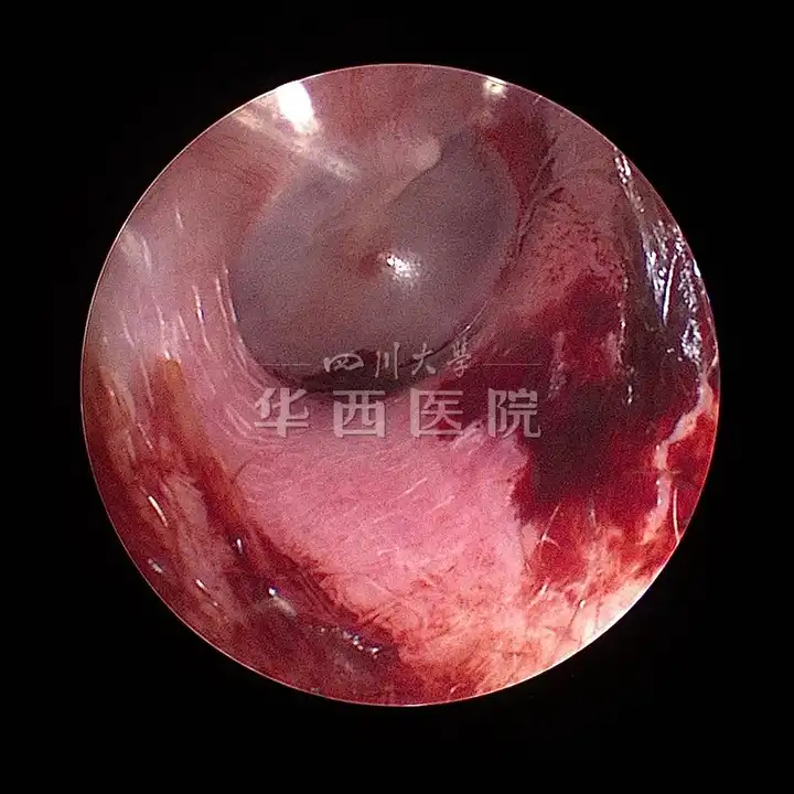 宝宝耳朵里的耳屎可以用挖耳勺取出来吗?