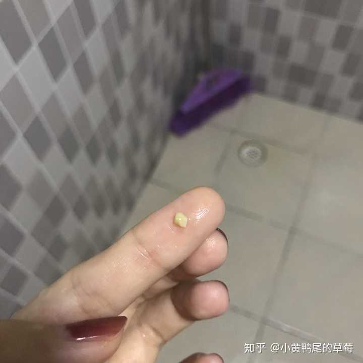 你见过最大的扁桃体结石有多大