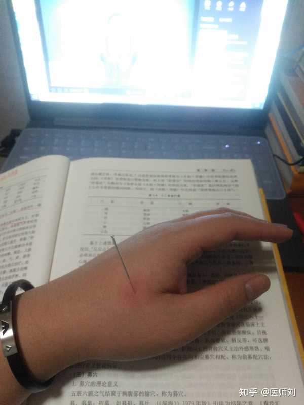 医师刘 的想法: 针灸合谷穴 针刺周围产生红晕 这就是"得… - 知乎