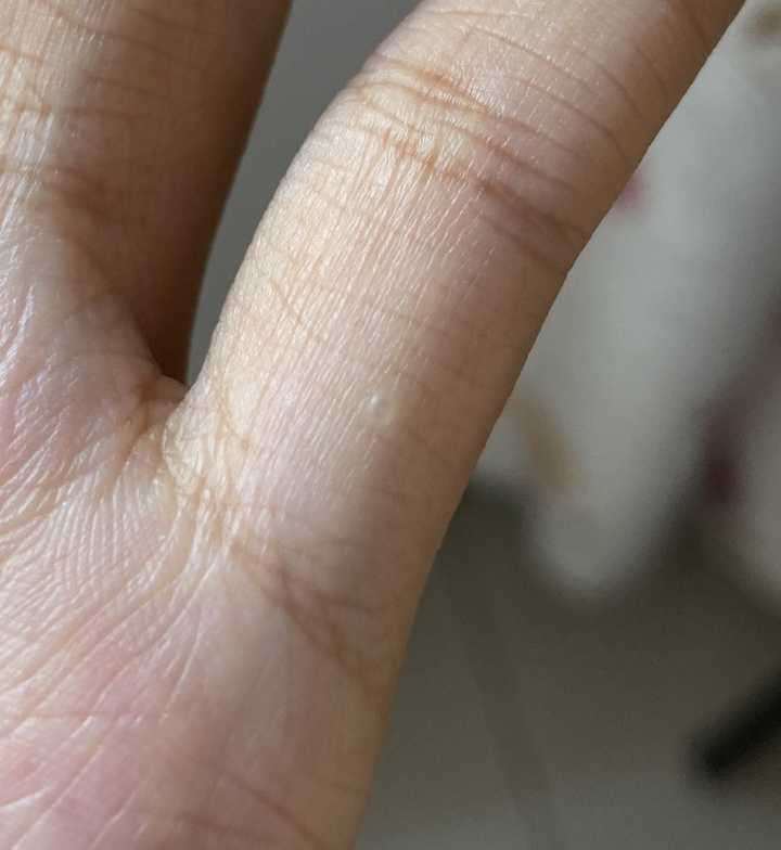 手指上长了很多不痛不痒的小疙瘩,像小水泡但是干的,这是怎么回事呢?
