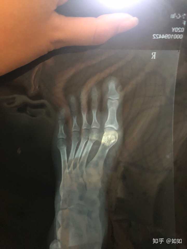大拇脚趾头骨折如何快速恢复