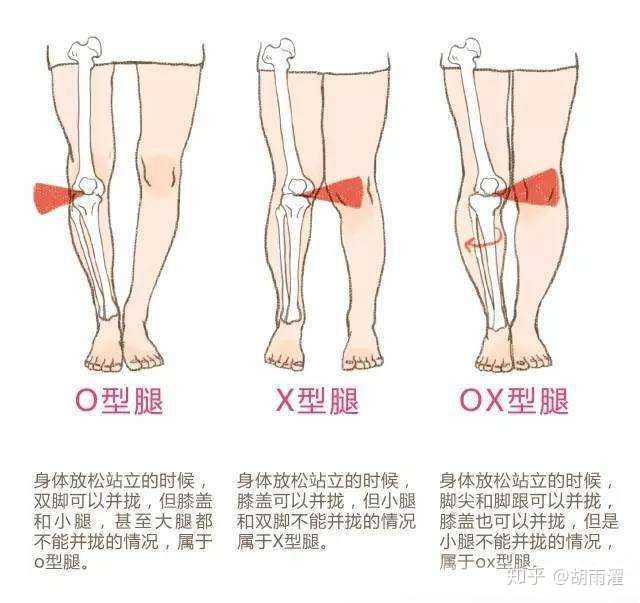 xo型腿自然站立时,膝内侧挤压,但是内八站立时膝内侧不挤压,所以久而