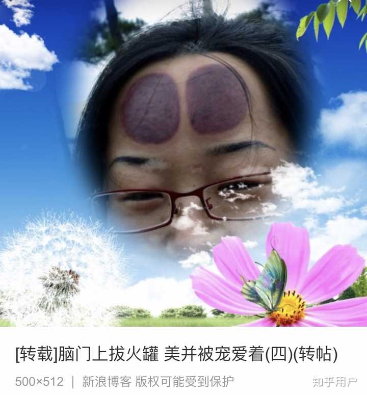 今天搜拔罐,搜出了一张谜一般的图片,配的文字是 "脑门拔火罐,美并被