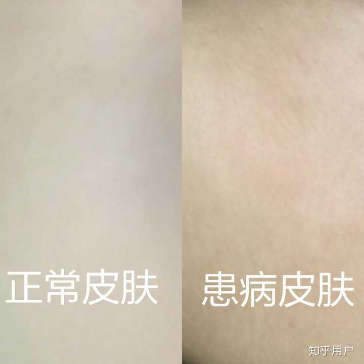 本人今年3月发现肚子和后腰出现类似花斑癣初期的白色