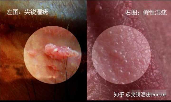 女性假性湿疣:导致女性患假性湿疣的原因,患病可能与念珠菌,滴虫感染