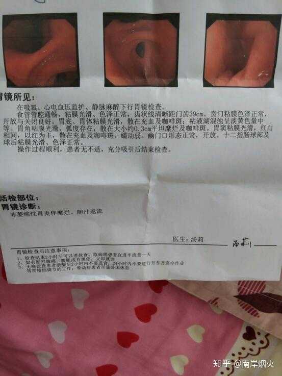 返流性胃炎 知乎