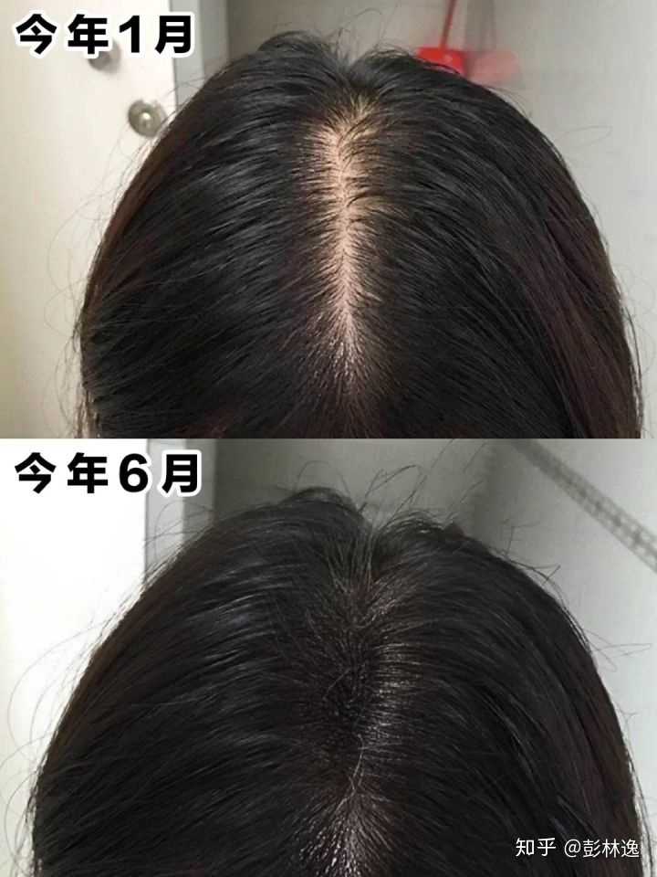 3亿,女性约0.7亿.脱发人口