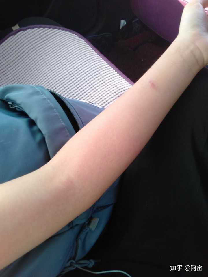 为何被蚊子叮过之后会整条手臂类似于顺着血管都红了?