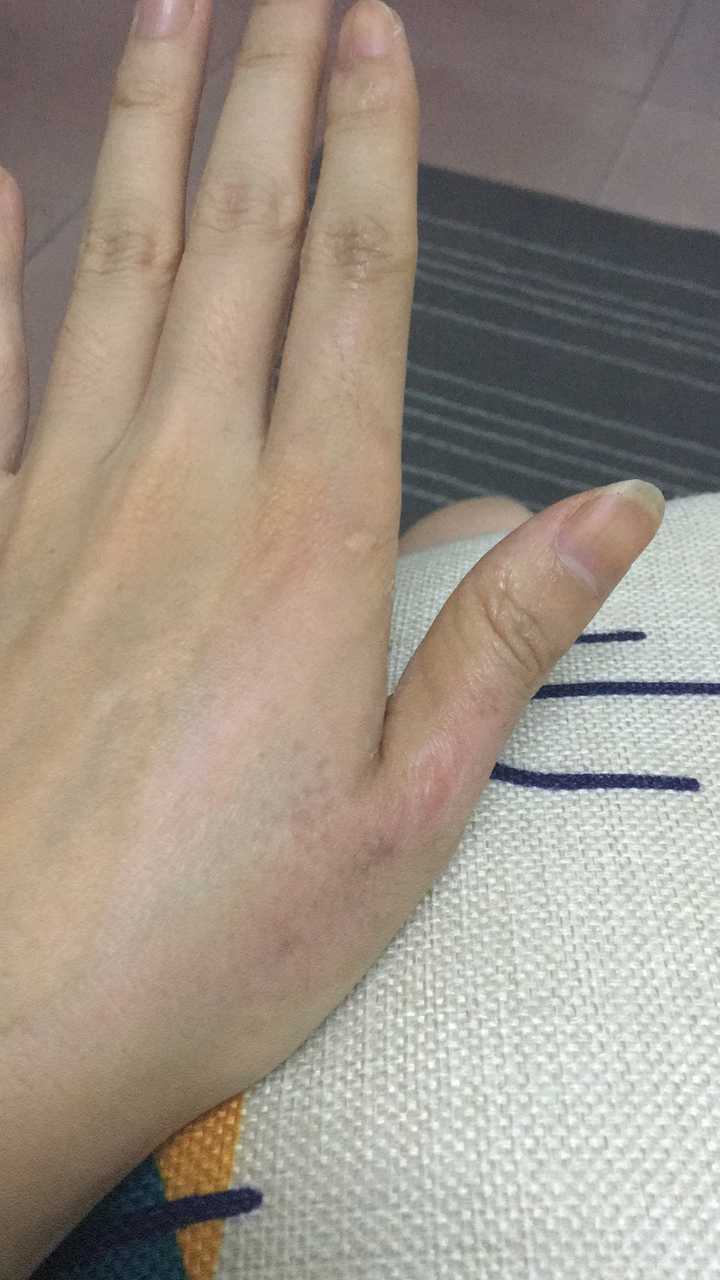 医生诊断我的属于二度烫伤,两周左右就能好,但是近期会有色素沉淀,最