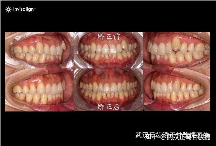 错颌畸形的类型进行 个性化正畸治疗,获得健康,美观,稳定的牙颌面型