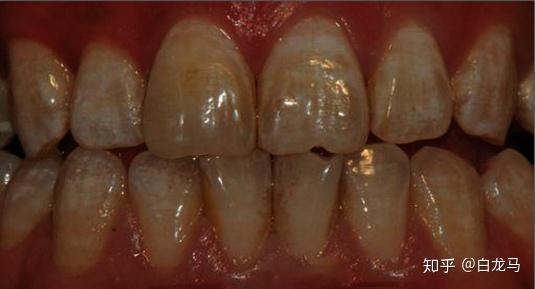 四环素沉积在牙本质内,会使牙齿变黄或者呈暗灰色
