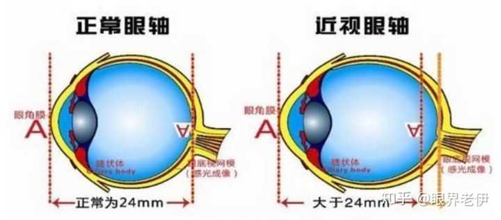 450度的近视不做手术可以恢复到正常视力吗