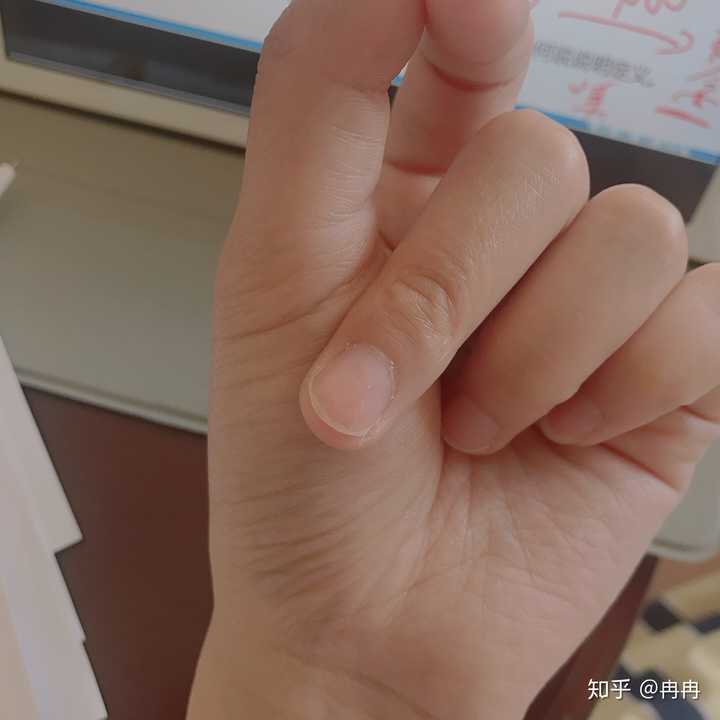 手指被门夹了,然后指甲里面四分之一有淤血,都两个月了还没好,怎么办?