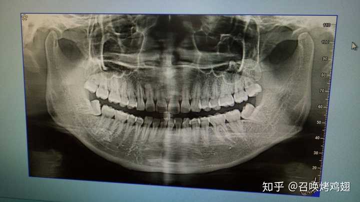 从牙片可以看出一共32颗牙,所以有四颗智齿,上面两颗还算比较正常