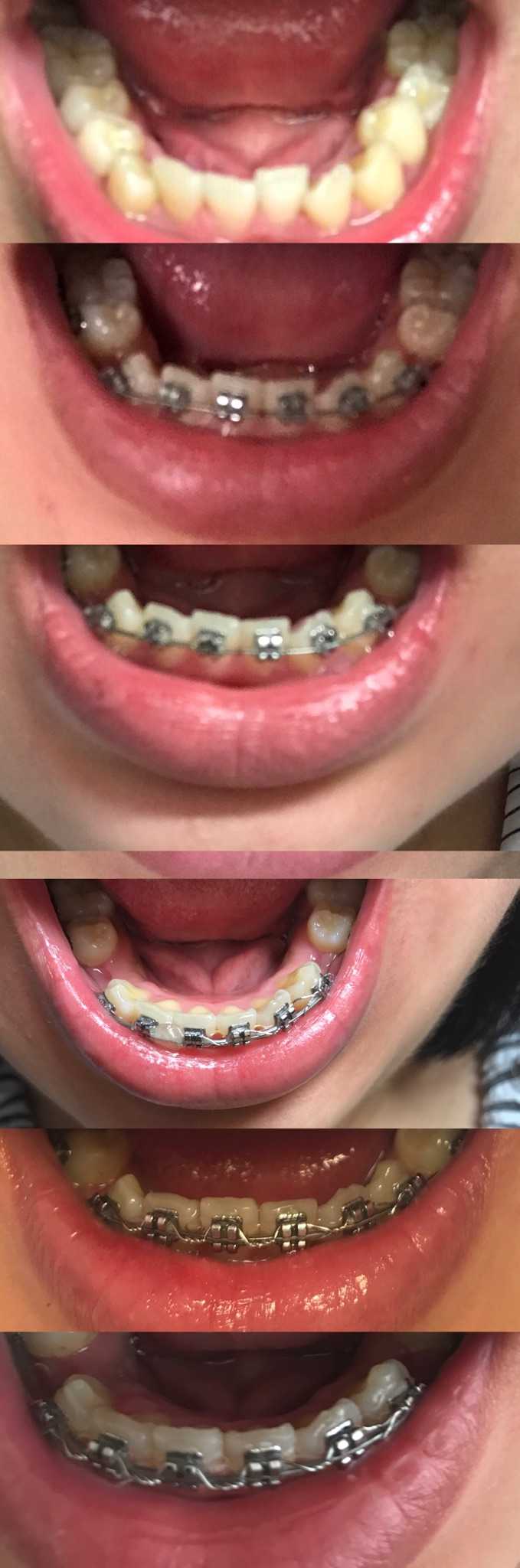 大龄男女青年,牙齿正畸并拔牙的过程感觉?