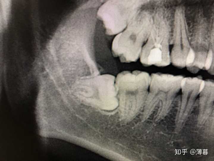 除了痛经能让我痛到怀疑人生,拔智齿还好,但是没拔之前还是害怕紧张