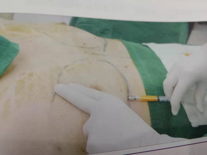自体脂肪隆胸效果如何?